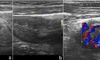 Estudio UEx prueba eficacia ecografa peditrica en deteccin precoz enfermedad de Crohn