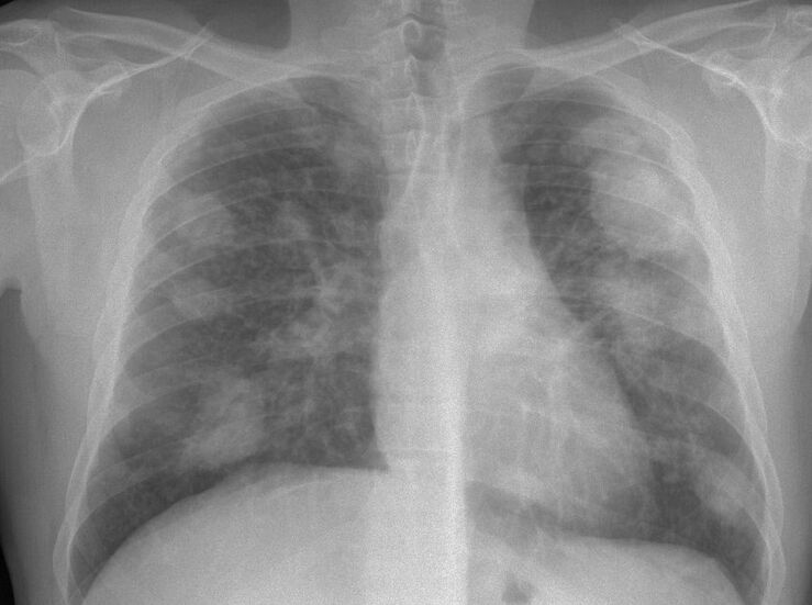 Extremadura presenta mucha ms incidencia de cncer de pulmn que el resto de CCAA